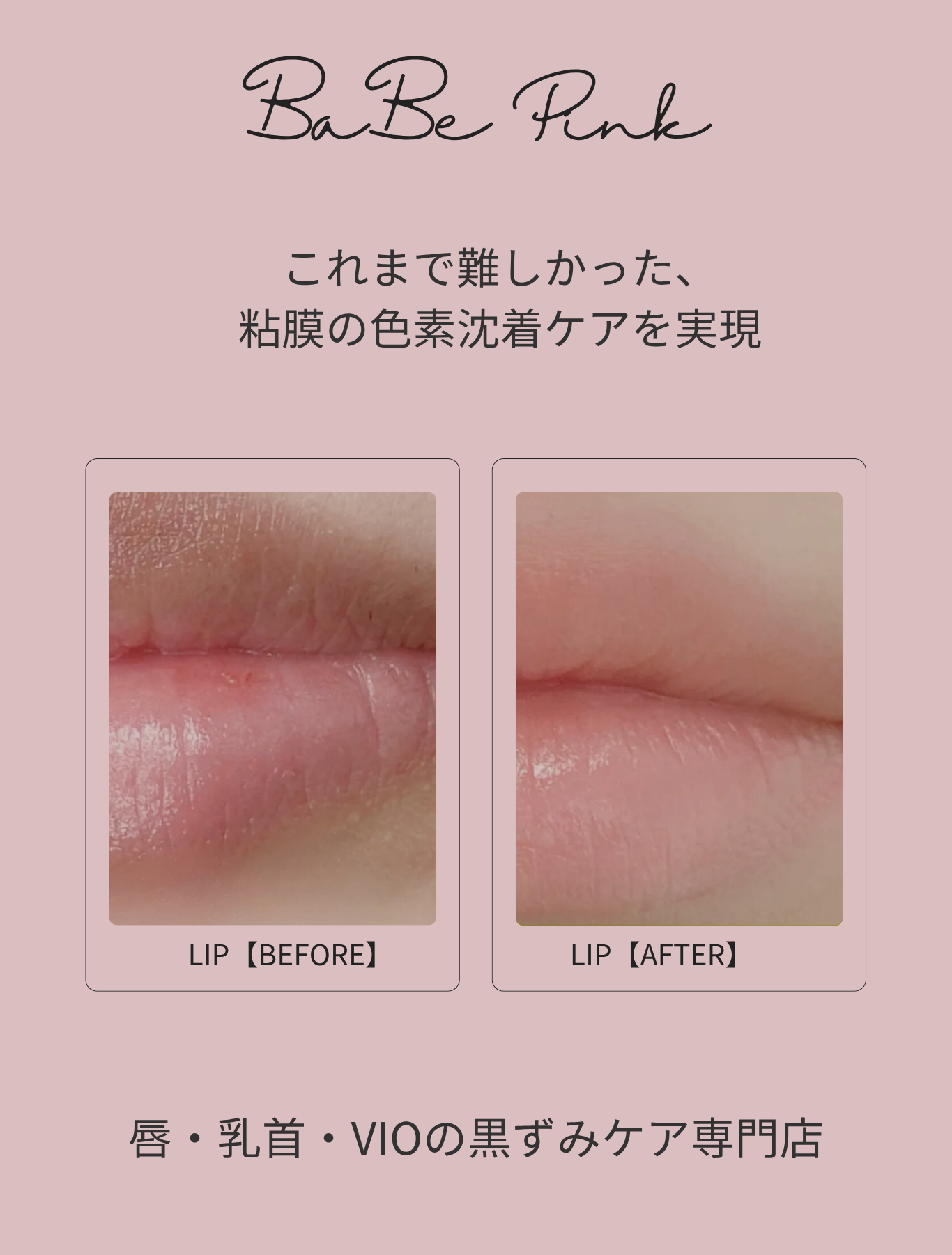 恵比寿のローマピンク正規サロン BaBe Pink ｜乳首・唇の黒ずみ